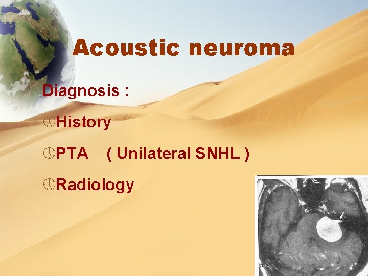 Acoustic neuroma Diagnosis : » History » PTA ( Unilateral SNHL ) » Radiology