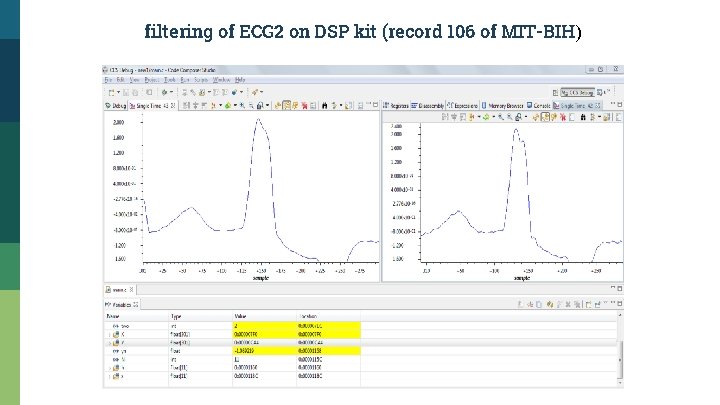 filtering of ECG 2 on DSP kit (record 106 of MIT-BIH) 