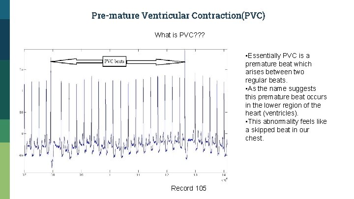 Pre-mature Ventricular Contraction(PVC) What is PVC? ? ? • Essentially PVC is a premature