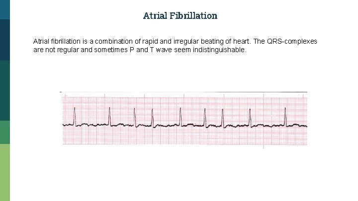 Atrial Fibrillation Atrial fibrillation is a combination of rapid and irregular beating of heart.