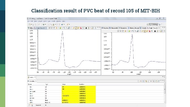 Classification result of PVC beat of record 105 of MIT-BIH 
