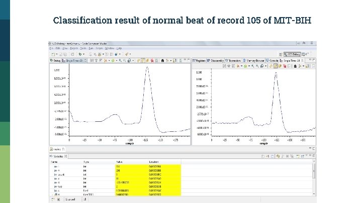 Classification result of normal beat of record 105 of MIT-BIH 