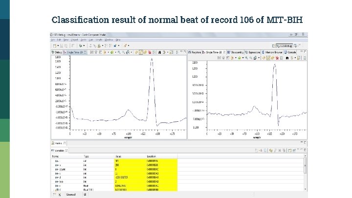 Classification result of normal beat of record 106 of MIT-BIH 