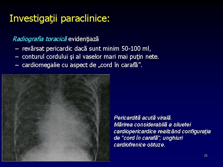 Investigaţii paraclinice: Radiografia toracică evidenţiază – revărsat pericardic dacă sunt minim 50 100 ml,