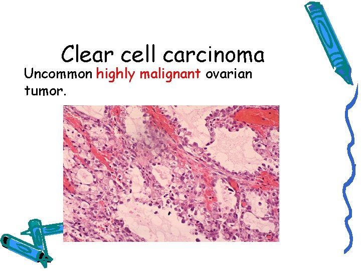 Clear cell carcinoma Uncommon highly malignant ovarian tumor. 