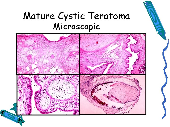 Mature Cystic Teratoma Microscopic 