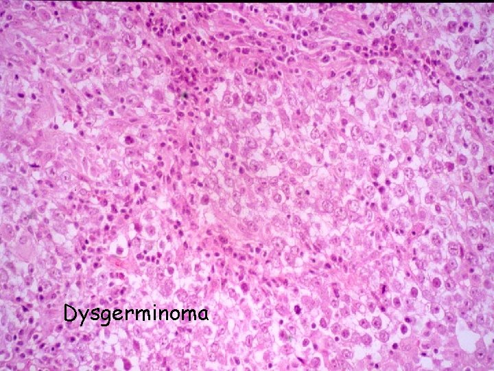 Dysgerminoma 
