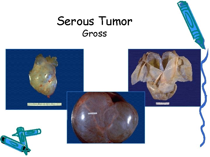 Serous Tumor Gross 