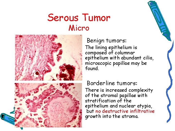 Serous Tumor Micro Benign tumors: The lining epithelium is composed of columnar epithelium with