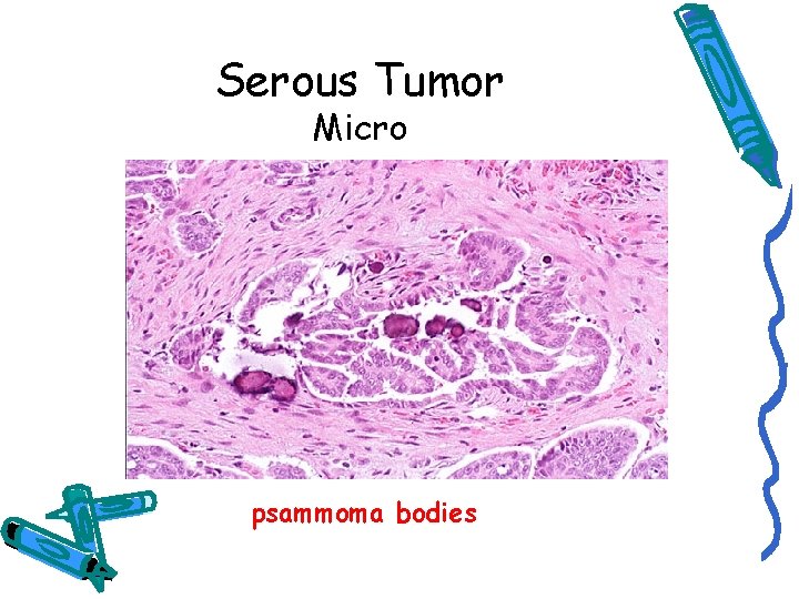 Serous Tumor Micro psammoma bodies 
