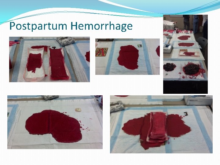 Postpartum Hemorrhage 