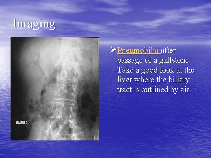 Imaging ØPneumobilia after passage of a gallstone. Take a good look at the liver