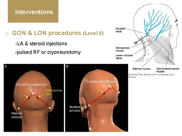 Interventions o GON & LON procedures (Level II) -LA & steroid injections -pulsed RF