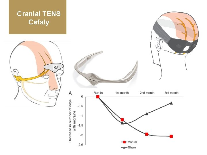 Cranial TENS Cefaly 