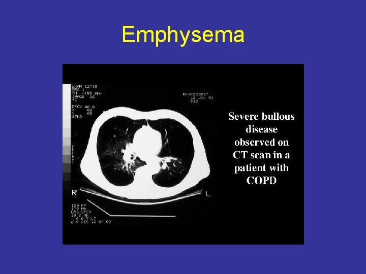 Emphysema 