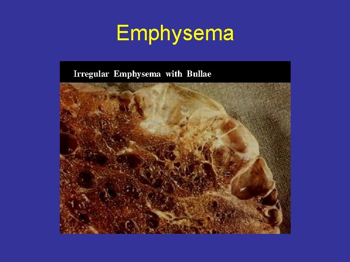 Emphysema 