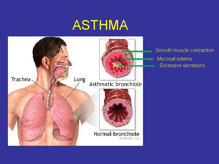 ASTHMA Smooth muscle contraction Mucosal edema Excessive secretions 