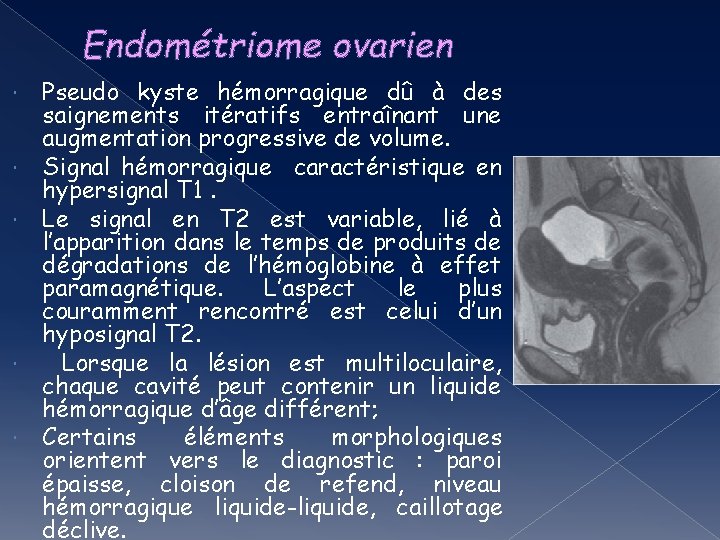 Endométriome ovarien Pseudo kyste hémorragique dû à des saignements itératifs entraînant une augmentation progressive