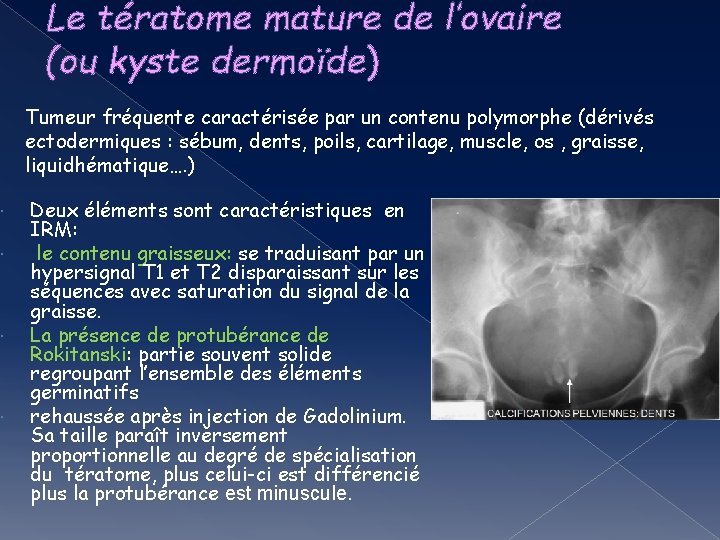 Le tératome mature de l’ovaire (ou kyste dermoïde) Tumeur fréquente caractérisée par un contenu