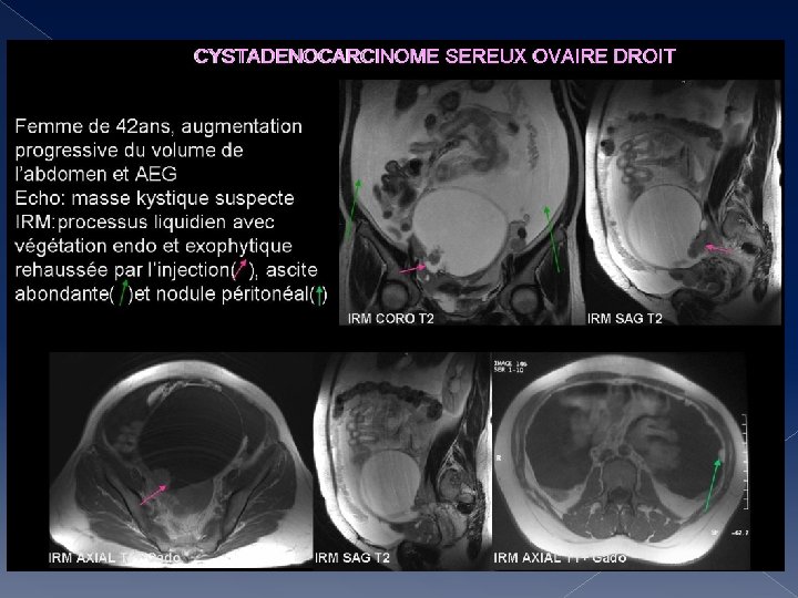  CYSTADENOCARCINOME SEREUX OVAIRE DROIT 