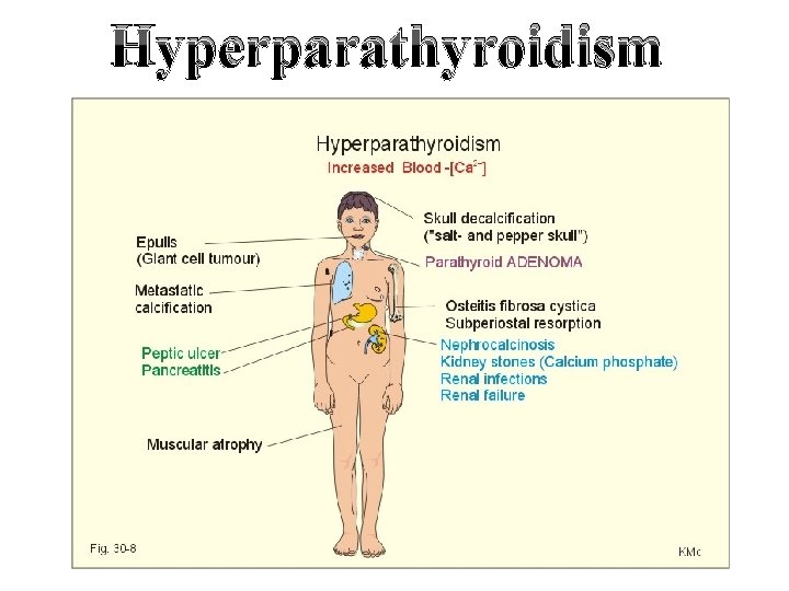 Hyperparathyroidism 