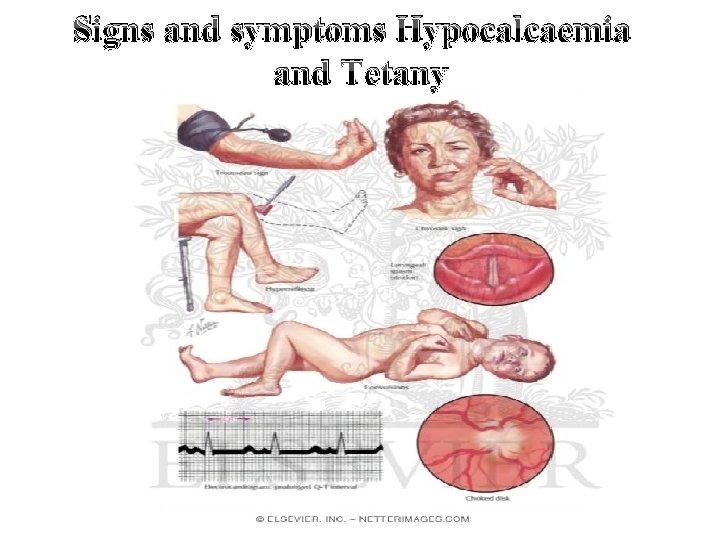 Signs and symptoms Hypocalcaemia and Tetany 