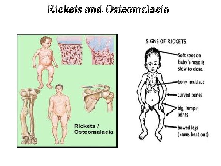 Rickets and Osteomalacia 