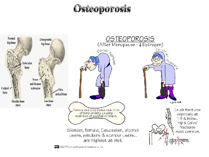 Osteoporosis 