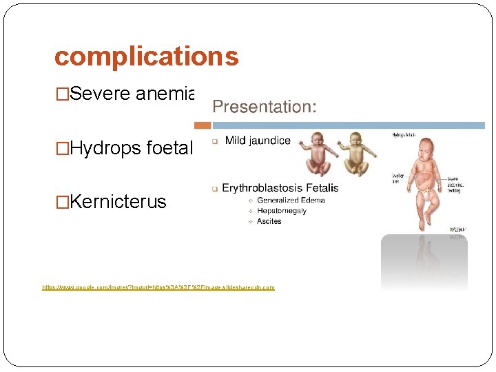 complications �Severe anemia �Hydrops foetalis �Kernicterus https: //www. google. com/imgres? imgurl=https%3 A%2 F%2 Fimage.