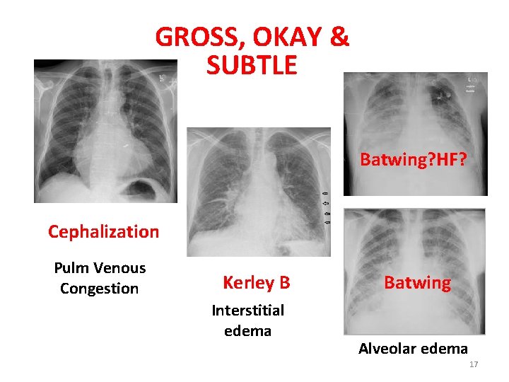 GROSS, OKAY & SUBTLE Batwing? HF? Cephalization Pulm Venous Congestion Kerley B Interstitial edema