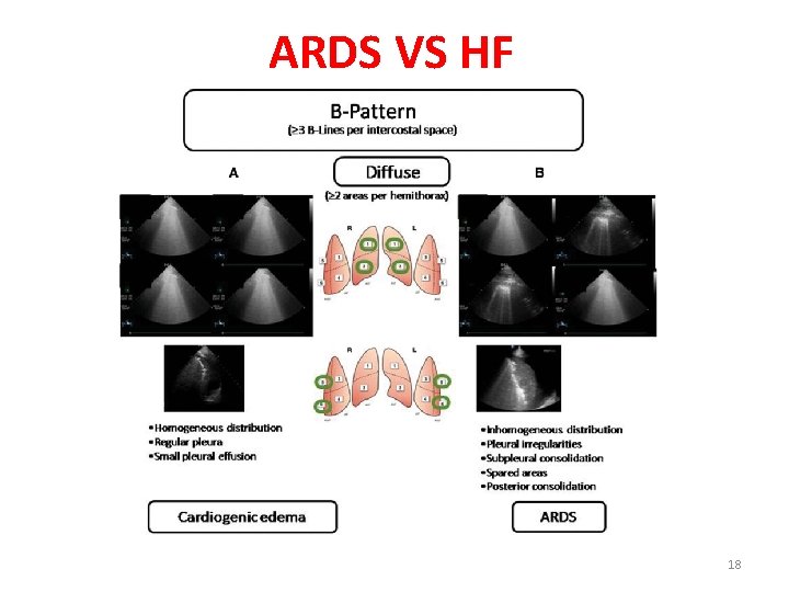 ARDS VS HF 18 