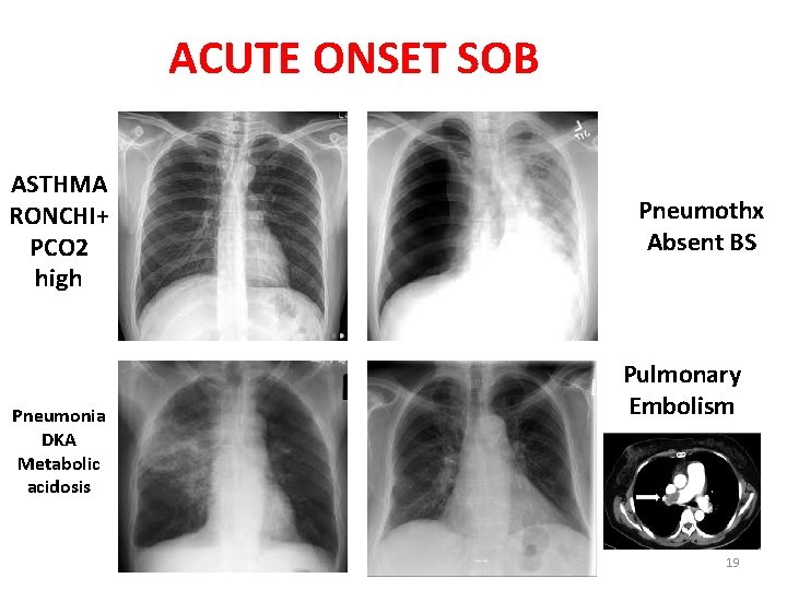 ACUTE ONSET SOB ASTHMA RONCHI+ PCO 2 high Pneumonia DKA Metabolic acidosis Pneumothx Absent