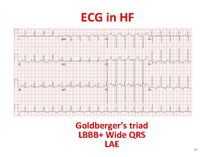 ECG in HF Goldberger’s triad LBBB+ Wide QRS LAE 20 