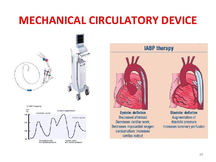 MECHANICAL CIRCULATORY DEVICE 29 