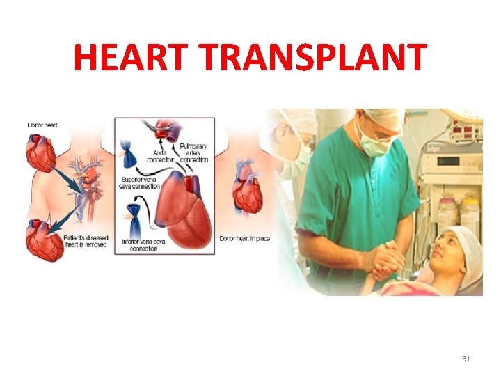 HEART TRANSPLANT 31 