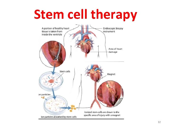 Stem cell therapy 32 