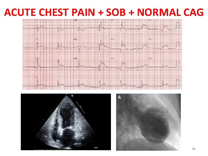 ACUTE CHEST PAIN + SOB + NORMAL CAG 36 