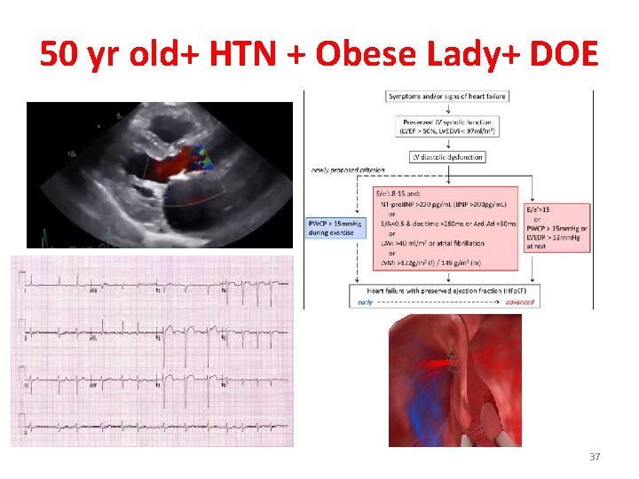 50 yr old+ HTN + Obese Lady+ DOE 37 