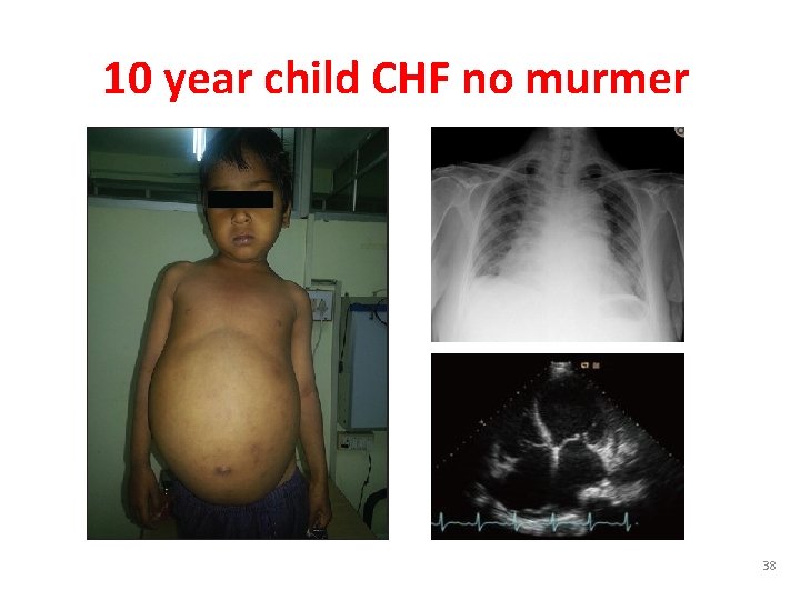 10 year child CHF no murmer 38 