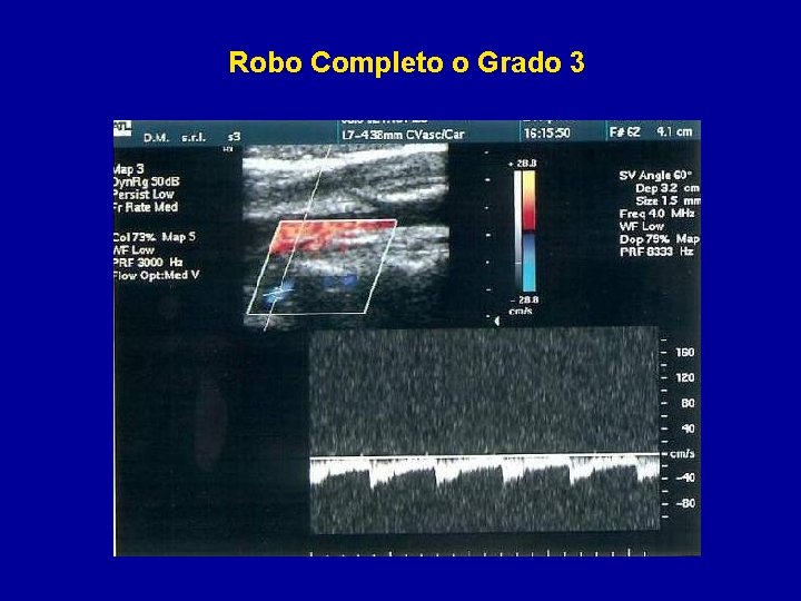 Robo Completo o Grado 3 