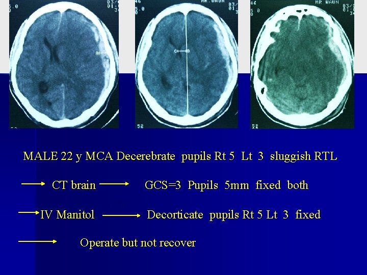 MALE 22 y MCA Decerebrate pupils Rt 5 Lt 3 sluggish RTL CT brain