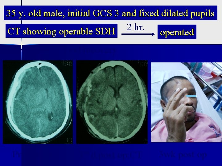 35 y. old male, initial GCS 3 and fixed dilated pupils CT showing operable