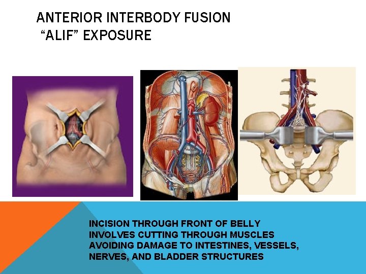 ANTERIOR INTERBODY FUSION “ALIF” EXPOSURE INCISION THROUGH FRONT OF BELLY INVOLVES CUTTING THROUGH MUSCLES