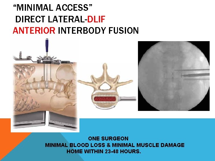 “MINIMAL ACCESS” DIRECT LATERAL-DLIF ANTERIOR INTERBODY FUSION ONE SURGEON MINIMAL BLOOD LOSS & MINIMAL