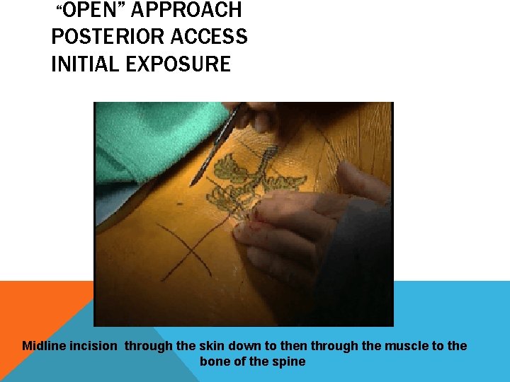 “OPEN” APPROACH POSTERIOR ACCESS INITIAL EXPOSURE Midline incision through the skin down to then