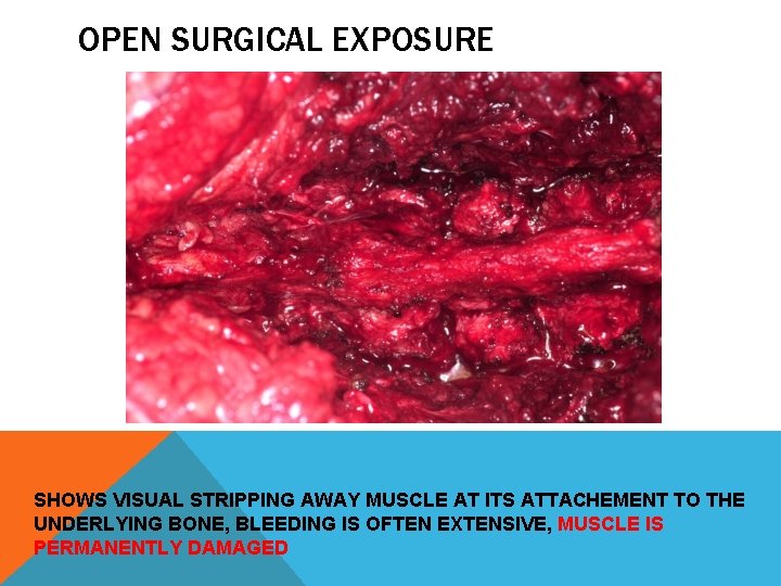 OPEN SURGICAL EXPOSURE SHOWS VISUAL STRIPPING AWAY MUSCLE AT ITS ATTACHEMENT TO THE UNDERLYING