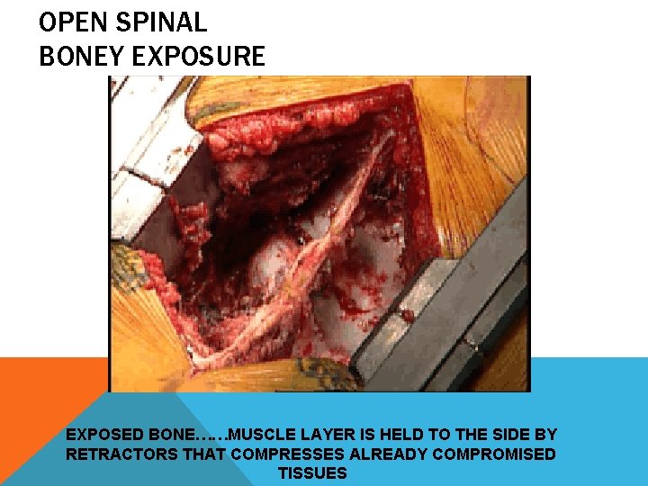 OPEN SPINAL BONEY EXPOSURE EXPOSED BONE……MUSCLE LAYER IS HELD TO THE SIDE BY RETRACTORS