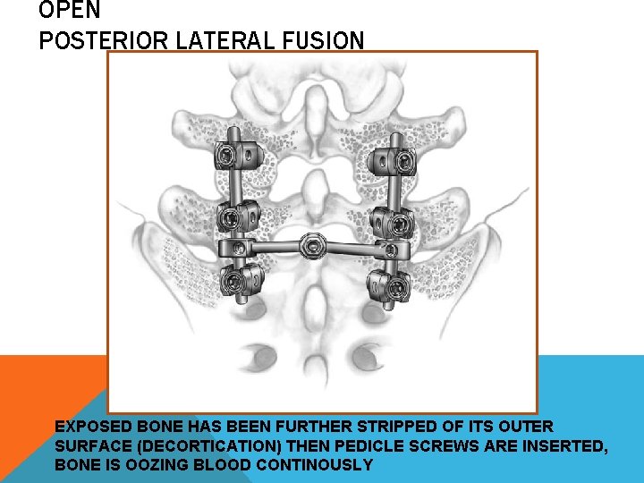 OPEN POSTERIOR LATERAL FUSION EXPOSED BONE HAS BEEN FURTHER STRIPPED OF ITS OUTER SURFACE