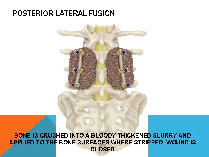 POSTERIOR LATERAL FUSION BONE IS CRUSHED INTO A BLOODY THICKENED SLURRY AND APPLIED TO