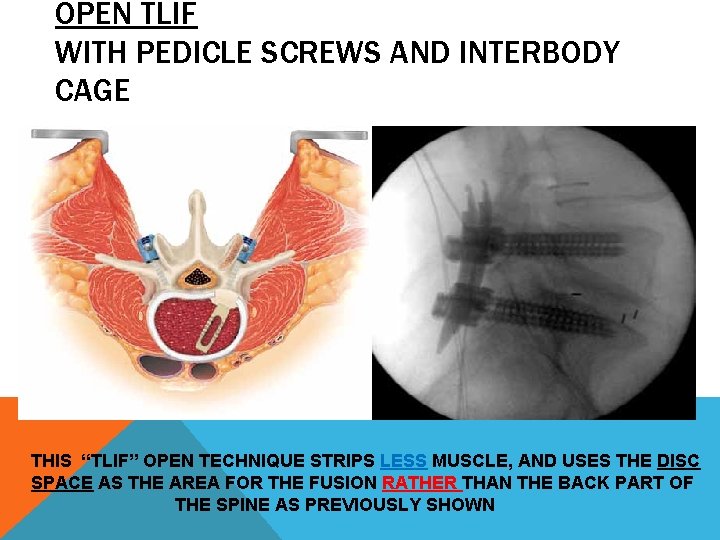 OPEN TLIF WITH PEDICLE SCREWS AND INTERBODY CAGE THIS “TLIF” OPEN TECHNIQUE STRIPS LESS